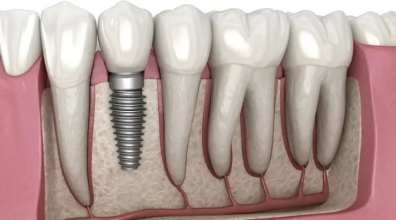 Revitalizing Your Smile and Boosting Your Confidence with Dental Implants