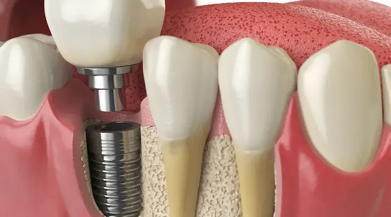 A Balanced Guide to Modern Tooth Replacement Options