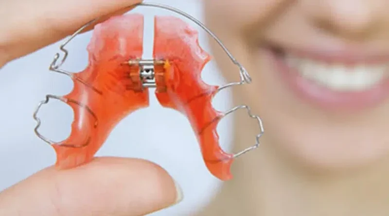 A Helpful Breakdown of Expander Use in Modern Orthodontics in Alpharetta