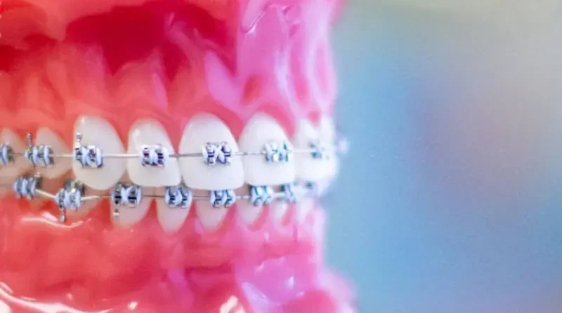 How Early Orthodontics for Children in North Vancouver Supports Healthy Jaw Growth