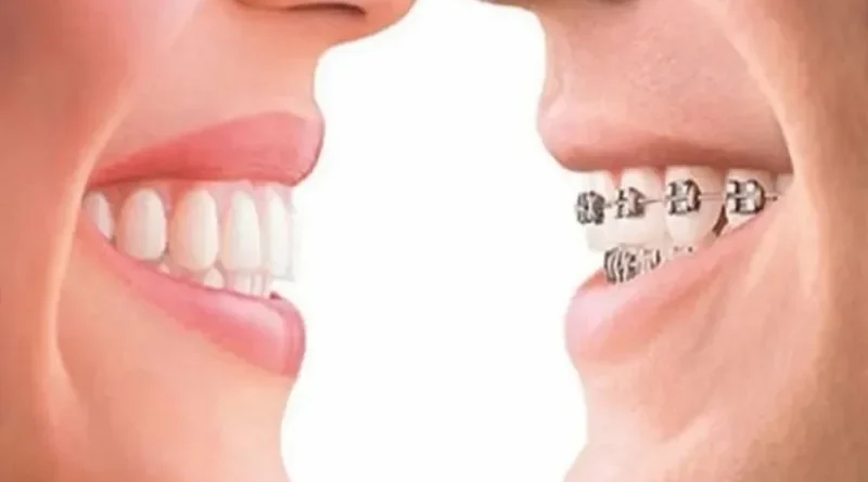 Essential Questions Richmond Patients Should Ask Before Starting Orthodontic Treatment