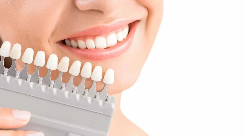 Dental Veneers vs. Bonding Understanding the Differences and Uses