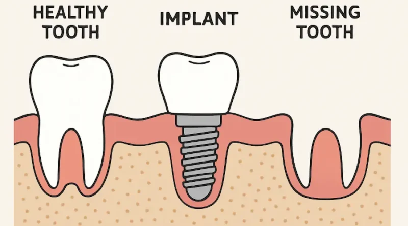 Essential Considerations Before Opting for Dental Implants